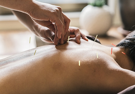 Frau erhält Akupunktur vom gut und günstig versicherten Heilpraktiker